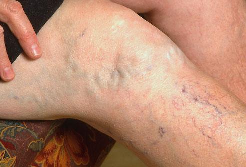 Varicose Veins Run in My Family — Can I Prevent Them?