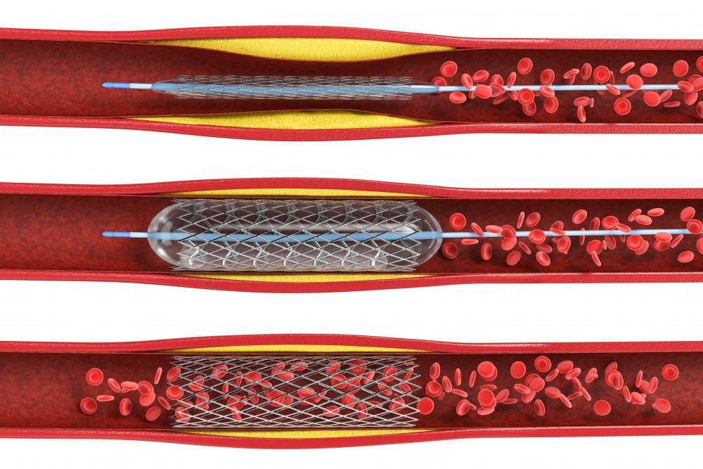 Do You Always Need a Stent After a Balloon Angioplasty?