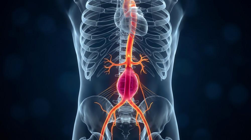 Abdominal Aortic Aneurysms (AAA): Risk Factors Every Man Should Know About 