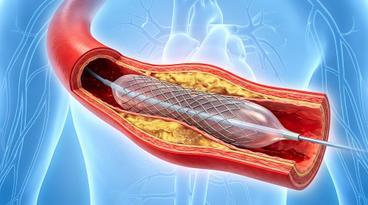 Angioplasty and Stenting to Treat a Heart Attack: How It Protects Your Heart Health